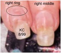 Damage from Methyl Metha-crylate